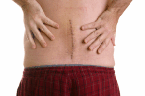 Post Spinal Surgery Pain Post-Laminectomy Pain Post Spinal Surgery Pain Post-Laminectomy Pain