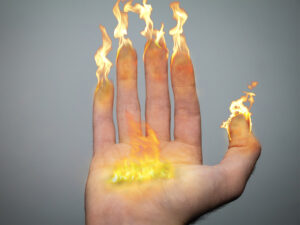 RSD CRPS Complex Regional Pain Syndrome 1