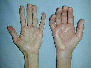 RSD CRPS Complex Regional Pain Syndrome 1