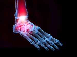 RSD CRPS Complex Regional Pain Syndrome 1