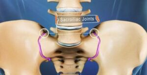 Sacro-iliac (SI) Joint Injections