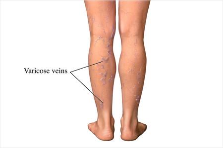 Varicose Veins 2