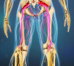 Introduction

Piriformis syndrome is a when the piriformis muscle, the muscle that begins at the lower spine and connect to the upper surface of the femur, irritates the sciatic nerve. The irritation of the sciatic nerve will then cause pain, numbness, and tingling through the

The piriformis muscle is essential for walking and maintaining proper balance. This muscle helps stabilize the hip and allows the thigh to properly move. 

The result of piriformis syndrome usually leads to a spinal disc herniation.  