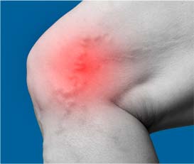 Varicose Veins